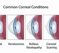 Image result for keratoconus contact lenses types