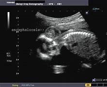 Image result for Encephalocele Ultrasound Images