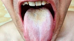 Image result for Yeast Infection On Tongue