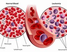 Image result for Leukemia Red Blood Cells