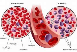 Image result for Leukemia Cancer Pictures