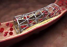 Image result for How Long Is Recovery From Heart Stents