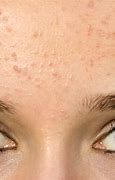 Image result for Pimples On Forehead 69