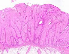 Image result for Verrucous Carcinoma Pictures