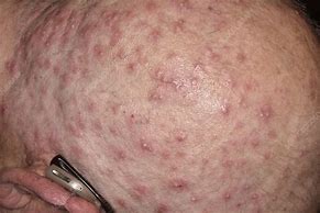 Image result for Severe Scalp Folliculitis