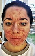 Image result for Severe Chronic Acne On Face