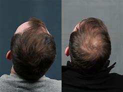 Image result for NeoGraft Hair Transplant