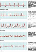 Image result for Degrees of Heart Block