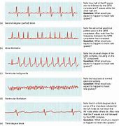 Image result for CPR ECG Wave Types