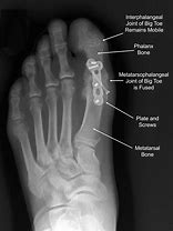 Image result for Bone Spur On Big Toe