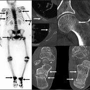 Image result for RSD Bone Scan