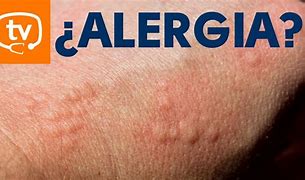 Image result for alergis