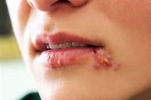 Image result for Syphilis Lip Sore
