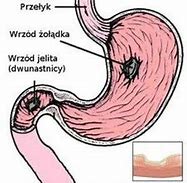 Image result for choroba_wrzodowa_żołądka
