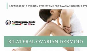 Image result for Bilateral Ovarian Dermoid Cysts