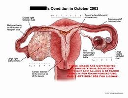 Image result for Large Ovary Masses