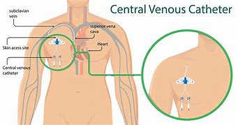 Image result for Central Venous Catheter Location
