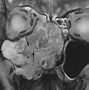 Image result for Sinonasal Papilloma Radiology
