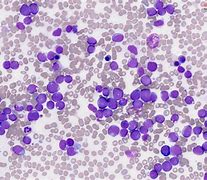 Image result for Acute Myeloid Leukemia without Maturation