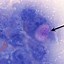 Image result for Transitional Cell Carcinoma