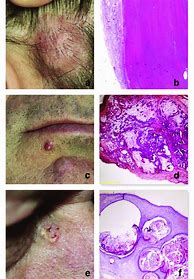 Image result for Right Adnexal Cyst