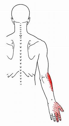 Subclavius The Trigger Point Amp Referred Guide