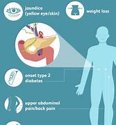 Image result for Pancreatic Cancer Pain Location