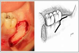 Image result for Flap Design Oral Surgery