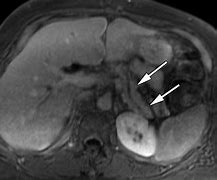 Image result for Pancreatic Cyst MRI