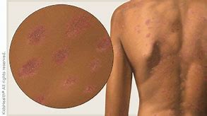 Image result for Pityriasis Rosea in Skin of Color