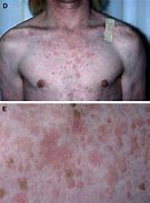 Image result for Images of HPV in Men