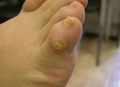 Image result for Calluses Warts Corns