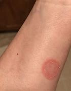Image result for Contagious Skin Rashes