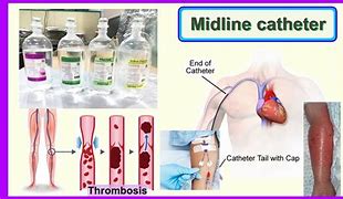 Image result for Midline Catheter Location