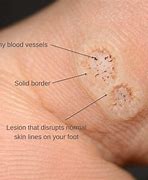 Image result for Dying Wart