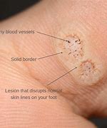 Image result for Seed Wart On Bottom of Foot