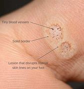 Image result for warts type and signs