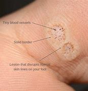 Image result for Burned Wart