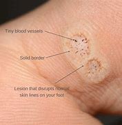 Image result for Stages of Wart Dying