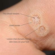 Image result for Stages of Wart Dying