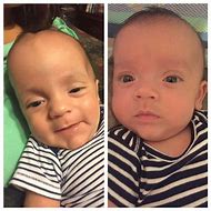 Image result for Hydrocephalus in Baby