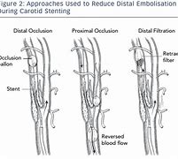 Image result for Carotid Artery Stent Surgery