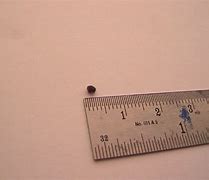 Image result for What Does a Kidney Stone Look Like 2Mm