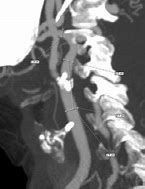 Image result for Carotid Stent Placement