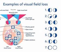 Image result for Central and Peripheral Vision