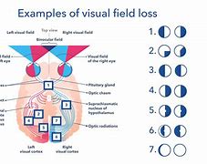 Image result for Peripheral Visual Field