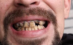 Image result for Very Bad Teeth