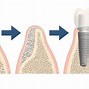 Image result for Swelling After Dental Bone Graft