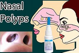 nasal polyps 的图像结果