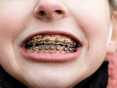 Image result for Rotten Teeth After Braces